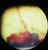 a hemorrhage in the retina from rodenticide poisoning
