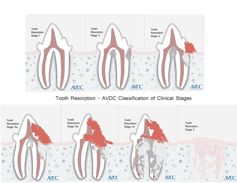 Diagram illustrating the stages of tooth resorption.