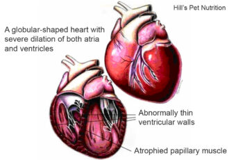 Illustration of heart showing Dilated cardiomyopathy