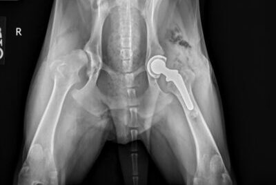 An x-ray of a total hip replacement