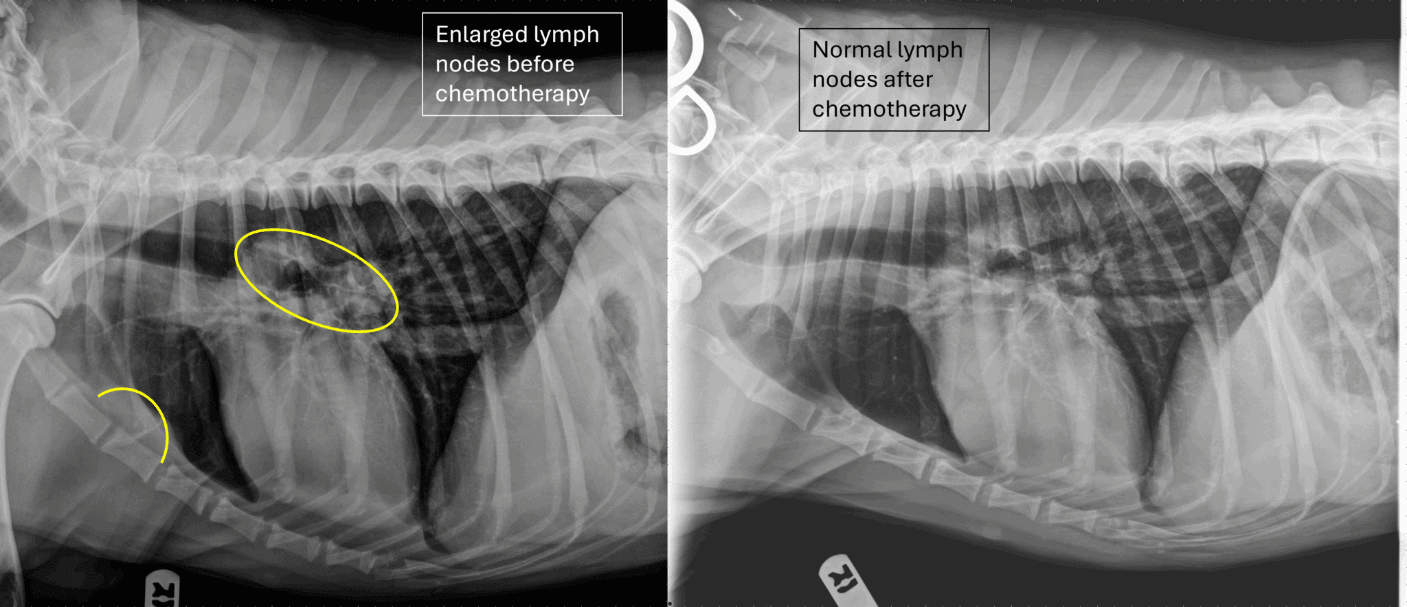 Two side-by-side x-rays showing enlarged lymph nodes before chemotherapy and a normal lymph node after chemotherapy
